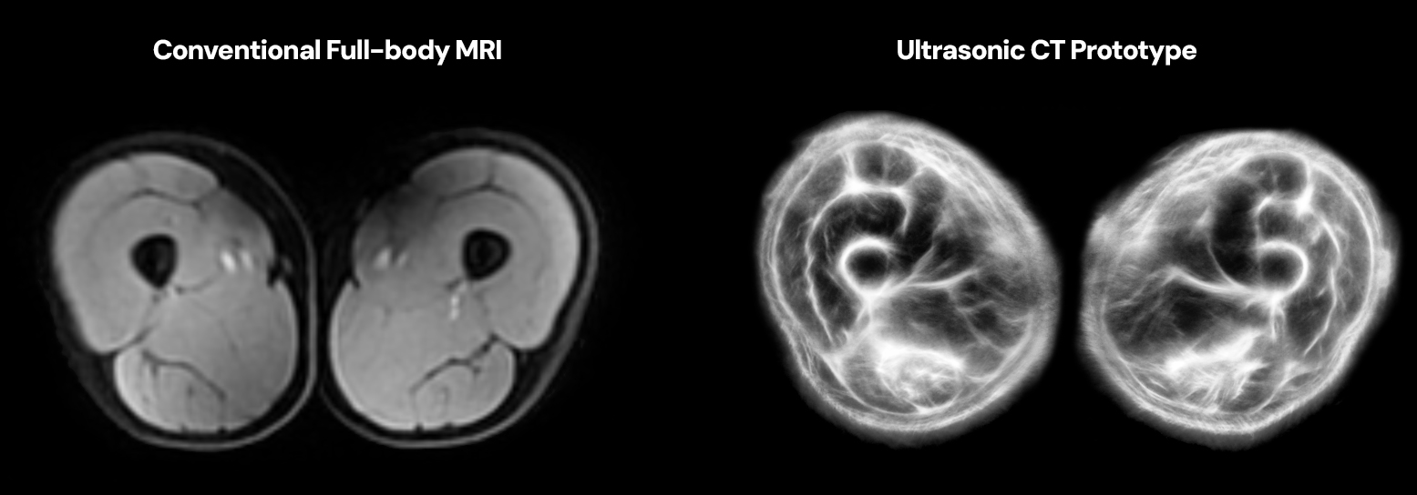 Side-by-side thigh scan comparison labeled conventional full-body MRI and ultrasonic CT prototype.